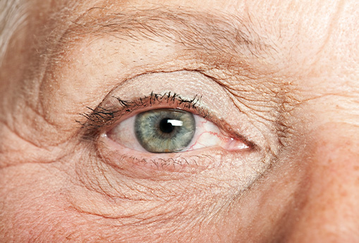 Enhancing Vision With Cataract Surgery